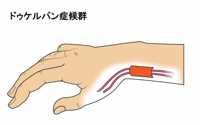 腱鞘炎のイラスト